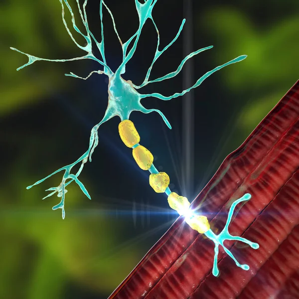 Demyelination of neuron, the damage of the neuron myelin sheath seen in demyelinating diseases, 3D illustration. Multiple sclerosis and other demyelinating myelinoclastic and leukodystrophic diseases