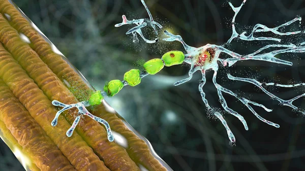 Afbraak Van Motorische Neuronen Conceptuele Illustratie Motorneuron Ziekten Zijn Een — Stockfoto