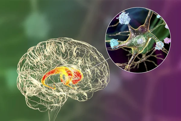 Inclusões Neuronais Núcleo Caudado Cérebro Doença Huntington Ilustração Inclusões São — Fotografia de Stock
