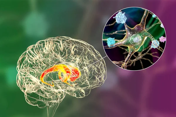 Huntington hastalığında beynin karnabaht çekirdeğine nöronal eklentiler, 3 boyutlu illüstrasyon. Sonuçlar mutasyona uğramış avlanma proteinlerinden oluşur, bunlar çekirdeklerde, aksonlarda ve dendritlerde bulunur.