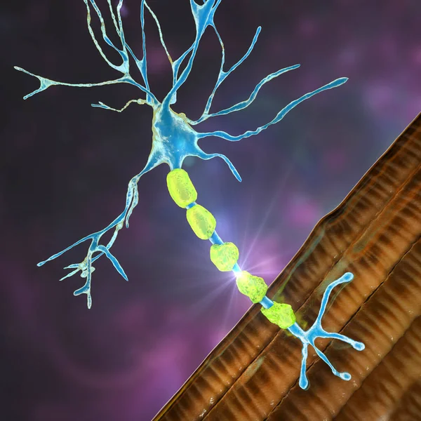 Demyelination of neuron, the damage of the neuron myelin sheath seen in demyelinating diseases, 3D illustration. Multiple sclerosis and other demyelinating myelinoclastic and leukodystrophic diseases