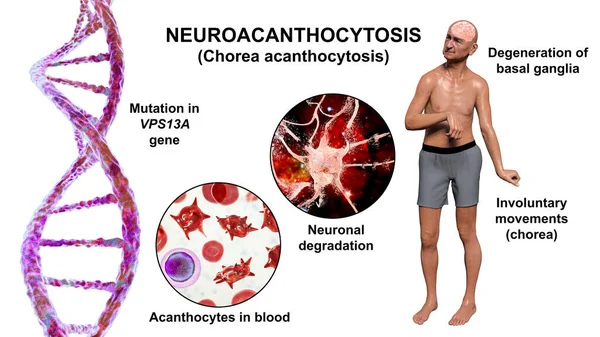 Neuroacantocitosis Corea Acantocitosis Una Enfermedad Neurodegenerativa Debido Mutación Gen Vps13A — Foto de Stock
