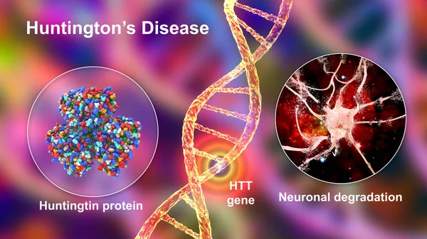 Penyakit Huntington Juga Dikenal Sebagai Chorea Huntington Penyakit Neurodegenerative Karena — Stok Foto