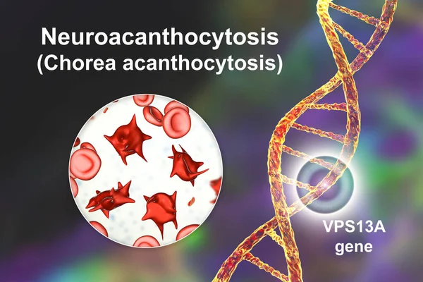 Vps13A基因突变引起的神经退行性疾病 即神经细胞病 其特征是血液中存在着无菌细胞 且有类固醇运动 — 图库照片