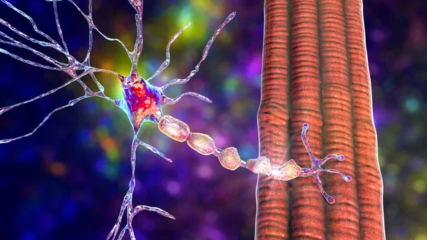 Demyelinisatie Van Neuron Beschadiging Van Neuron Myeline Schede Gezien Demyeliniserende — Stockfoto