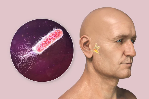 Pseudomonas aeruginosa bacterium as a cause of otitis media. 3D illustration showing purulent inflammation of the middle ear in a male person and close-up view of Pseudomonas bacteria