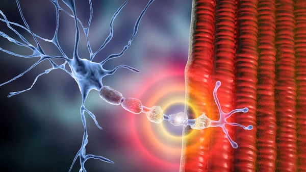 Demyelination Neuron Damage Neuron Myelin Sheath Seen Demyelinating Diseases Illustration — Stock Photo, Image