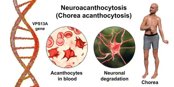 Neuroacanthocytosis Chorea Acanthocytosis Vps13A 유전자 돌연변이로 발생하는 퇴행성 이것은 피속에 — 스톡 사진