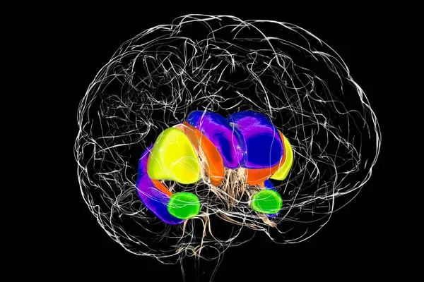 Rysunki Grzbietowe Komory Boczne Mózgu Osoby Chorobą Huntingtona Ilustracja Pokazująca — Zdjęcie stockowe