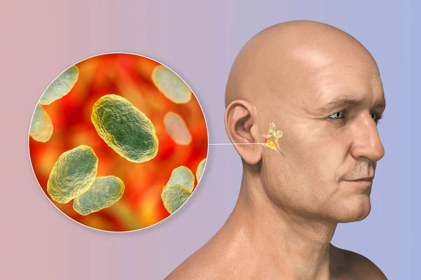 Hemophilus Influenzae Bakterie Jako Příčina Zánětu Středního Ucha Ilustrace Ukazující — Stock fotografie