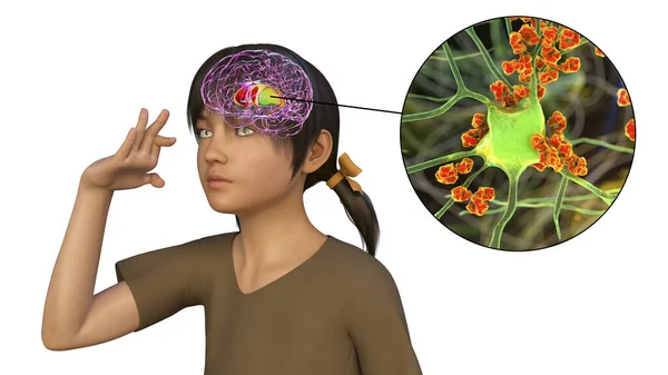 Anti-neuronal antibodies, anti-basal ganglia antibodies. 3D illustration shows immunoglobulins attacking neurons in the dorsal striatum of a girl's brain. They are found in post-rheumatic fever chorea