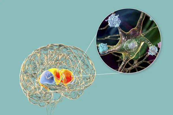 Neuronale Einschlüsse Bei Der Huntington Krankheit Illustration Einschlüsse Bestehen Aus — Stockfoto