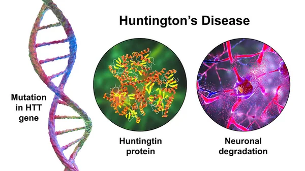 Penyakit Huntington Juga Dikenal Sebagai Chorea Huntington Penyakit Neurodegenerative Karena — Stok Foto