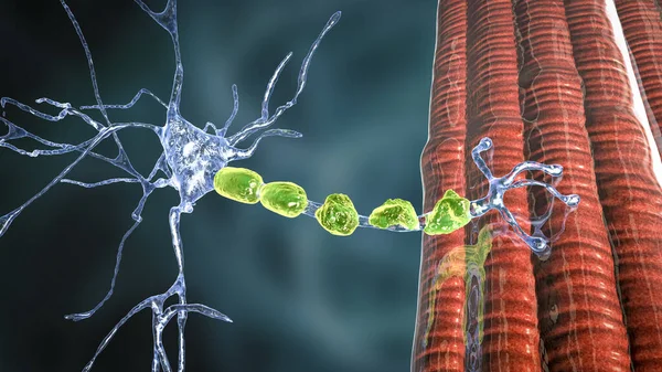 Demyelination Neurone Damage Neuron Myelin Sheath Seen Demyelinating Diseases Illustration — Photo