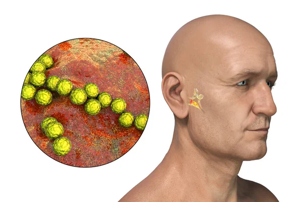 Streptococcus Bacterium Como Causa Otite Média Ilustração Mostrando Inflamação Purulenta — Fotografia de Stock