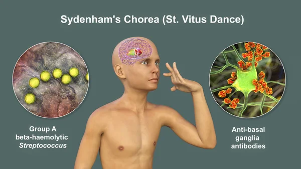 Sydenham\'s chorea, an autoimmune disease that results from Streptococcus infection, formation of anti-neuronal antibodies damaging brain basal ganglia that cause involuntary movements, 3D illustration