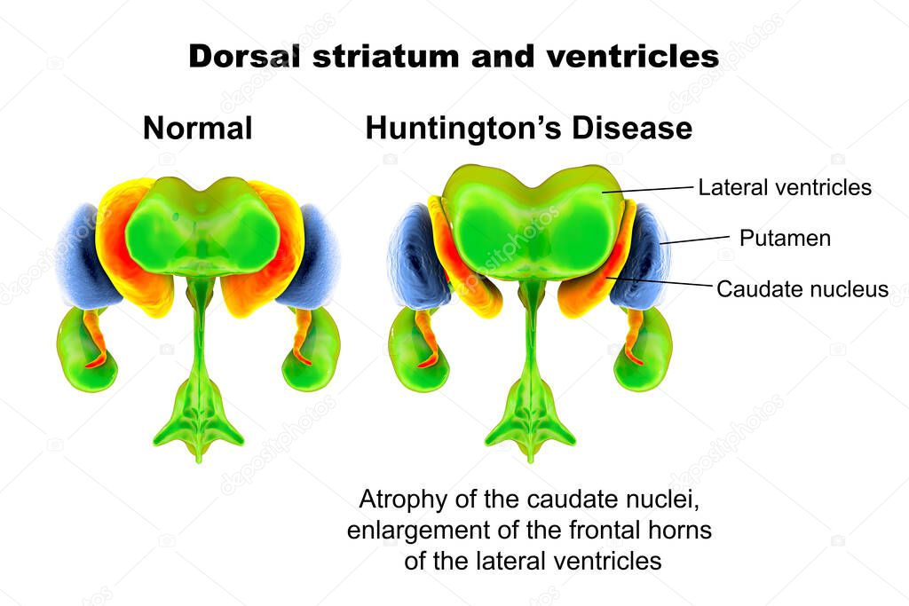 Dorsal striatum and lateral ventricles normal and in Huntington's disease (HD), 3D illustration showing enlargement of anterior horns of lateral ventricles and atrophy of the caudate nuclei in HD