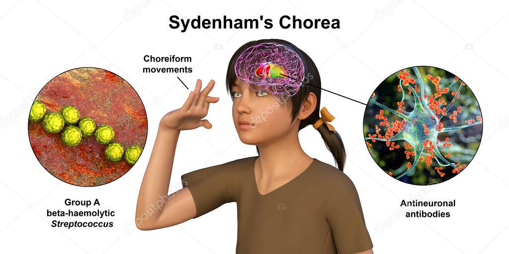 Sydenham's chorea, an autoimmune disease that results from Streptococcus infection, formation of anti-neuronal antibodies damaging brain basal ganglia that cause involuntary movements, 3D illustration