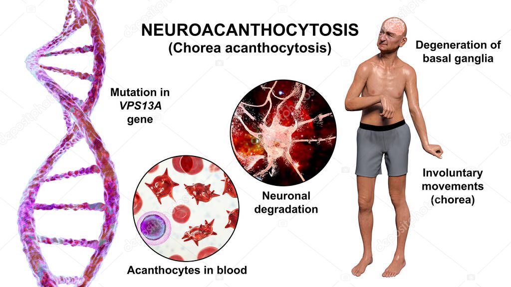Neuroacanthocytosis, Chorea acanthocytosis, a neurodegenerative disease due to mutation in the gene VPS13A, it is marked by presence of acanthocytes in blood and choreiform movements, 3D illustration
