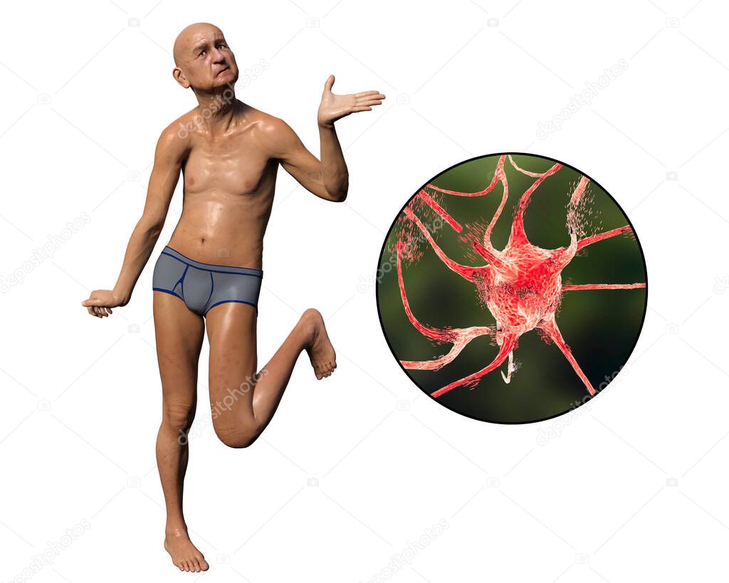 A person with chorea disease and close-up view of neuronal degradation which results of choreiform movements, conceptual 3D illustration