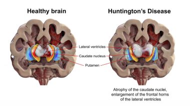 Sırt striatumu ve sağlıklı beyinde yanal ventriküller ve Huntington hastalığında, 3 boyutlu illüstrasyon gösteriyor ki ön ventriküllerin boynuzları genişlemiş ve HD 'deki ikaz çekirdeklerinde körelme görülüyor.