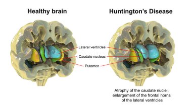 Sırt striatumu ve sağlıklı beyinde yanal ventriküller ve Huntington hastalığında, 3 boyutlu illüstrasyon gösteriyor ki ön ventriküllerin boynuzları genişlemiş ve HD 'deki ikaz çekirdeklerinde körelme görülüyor.
