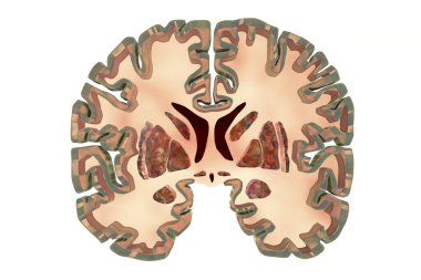 Sağlıklı bir beynin koronal bölümü bazal baglia ve ventriküllerin normal anatomisini gösteriyor.