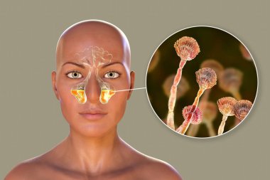 Aspergillus fungi as a cause of sinusitis. 3D illustration showing inflammation of maxillary sinuses in a female and close-up view of Aspergillus fungus. Chronic fungal rhinosinusitis clipart