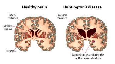 Huntington hastalığındaki koronal beyin bölümleri yan ventriküllerin genişlemiş ön boynuzlarını, sırt striatumunun dejenerasyonunu ve körelmesini gösteriyor.