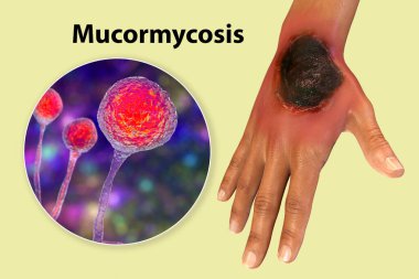 Cutaneous mucormycosis, siyah mantar olarak da bilinen mantar mantarının sebep olduğu bir hastalık, cilt eğriliğini ve mukoza mantarının yakın görüntüsünü gösteren 3 boyutlu bir illüstrasyon. Covid-19 komplikasyonu