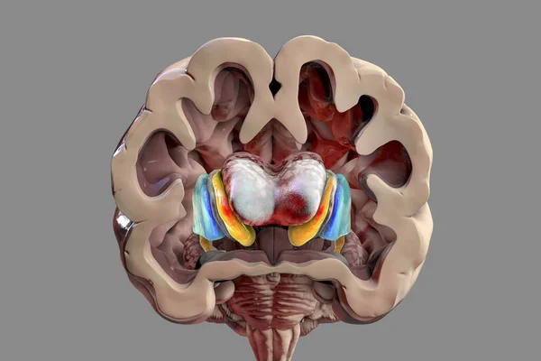Dorsal striatum and lateral ventricles in Huntington\'s disease, 3D illustration showing enlargement of the anterior horns of the lateral ventricles and atrophy of the caudate nuclei