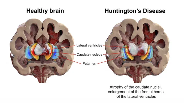 健康大脑和亨廷顿疾病中的背侧纹状体和侧脑室 3D显示Hd中侧脑室前角增大和尾状核萎缩 — 图库照片