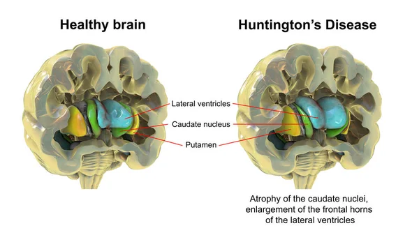 Dorsal Striatum Och Laterala Ventriklar Frisk Hjärna Och Vid Huntingtons — Stockfoto