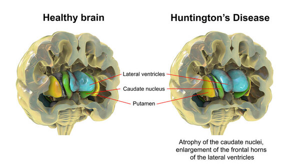 Дорсальная полоса и боковые желудочки в здоровом мозге и при болезни Хантингтона, 3D иллюстрация, показывающая расширение передних рогов боковых желудочков и атрофию ядер каудата в HD