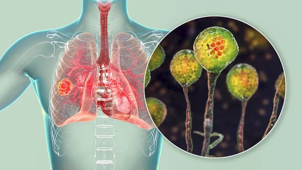 Tüdő Mucormycosis Egy Tüdőbetegség Okozta Gombák Nyálka Más Néven Fekete — Stock Fotó