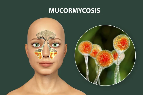 Mucor Fungi Cause Sinusitis Illustration Inflammation Maxillary Sinuses Close View — Stock Photo, Image