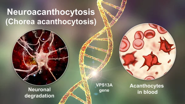 Neuroacanthocytosis Chorea Acanthocytosis Neurodegenerative Disease Due Mutation Gene Vps13A Marked — Stock Photo, Image