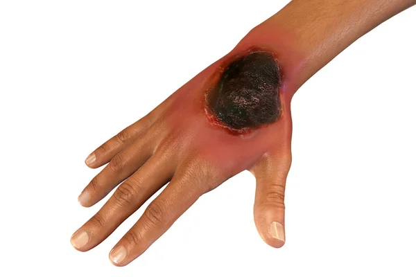 皮肤粘液支原体病 或皮肤粘液支原体病 一种由真菌粘液支原体引起的疾病 也被称为黑色真菌 在免疫缺损患者中 Covid 19并发症 3D图例 — 图库照片