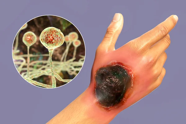Mucormicose Cutânea Uma Doença Causada Por Fungos Mucor Também Conhecido — Fotografia de Stock