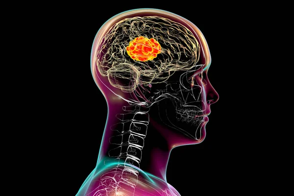 真菌による脳の病変である脳粘膜炎真菌とも呼ばれる真菌 3Dイラスト — ストック写真