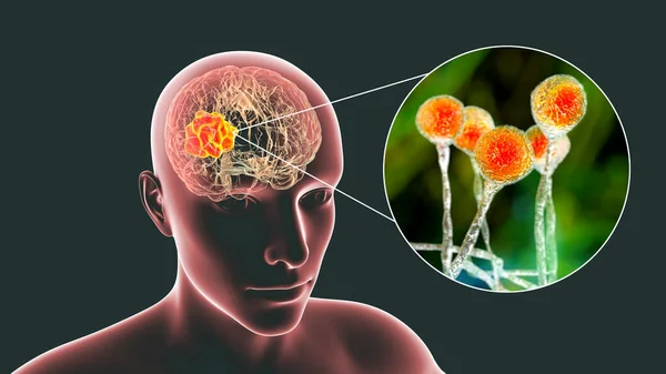 Mucormicosis Cerebral Una Lesión Cerebral Causada Por Hongos Mucor También — Foto de Stock