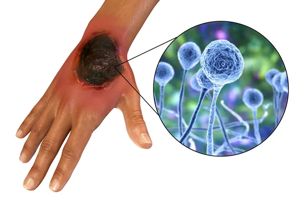 皮肤粘液真菌病是由真菌Mucor引起的一种疾病 也被称为黑色真菌 3D图片说明了粘液真菌病的皮肤渗漏和近视 Covid 19并发症 — 图库照片