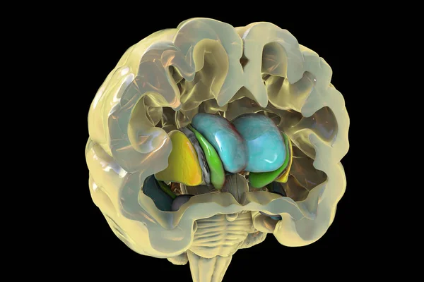 Estrato Dorsal Ventrículos Laterales Enfermedad Huntington Ilustración Que Muestra Agrandamiento — Foto de Stock