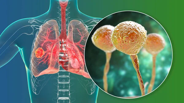 Mucormicosis Pulmonar Una Enfermedad Pulmonar Causada Por Hongos Mucor También —  Fotos de Stock