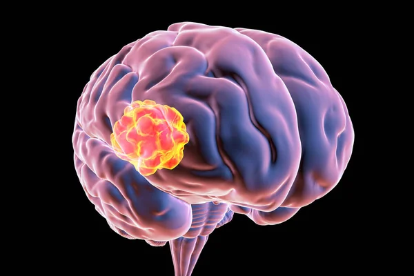 Mucormicosis Cerebral Una Lesión Cerebral Causada Por Hongos Mucor También — Foto de Stock