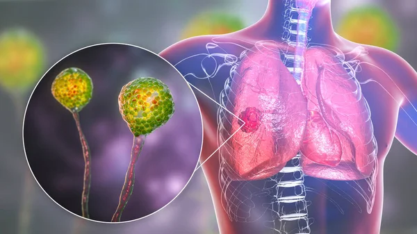 Mukormykoza Płuc Choroba Płuc Spowodowana Przez Grzyby Mucor Znany Również — Zdjęcie stockowe