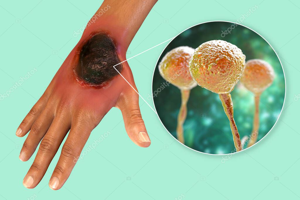 Mucormicosis cutánea, una enfermedad causada por hongos Mucor, también