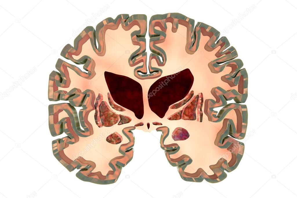 Coronal section of a brain of a person with Huntington's disease showing enlarged anterior horns of the lateral ventricles, degeneration and atrophy of the dorsal striatum, 3D illustration