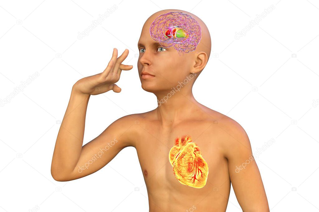 A boy with Sydenham's chorea and involuntary movements of a hand, 3D illustration. An autoimmune disease after Streptococcus infection due to antibodies against cells of brain basal ganglia and heart
