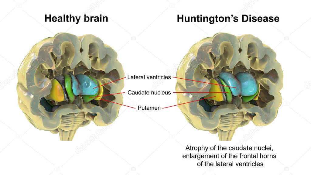 Dorsal striatum and lateral ventricles in healthy brain and in Huntington's disease, 3D illustration showing enlargement of anterior horns of lateral ventricles and atrophy of the caudate nuclei in HD